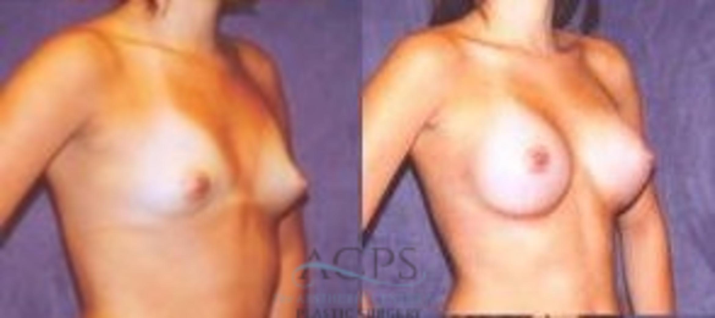 Before & After Breast Augmentation Case 1021 Oblique View: View in Houston, TX
