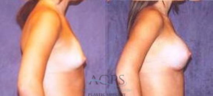Before & After Breast Augmentation Case 1021 Side View: View in Houston, TX
