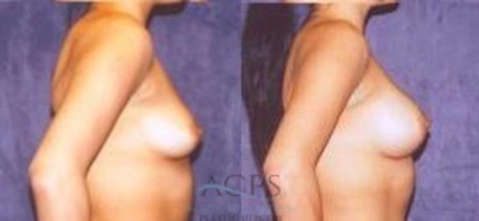 Before & After Breast Augmentation Case 1022 Side View: View in Houston, TX