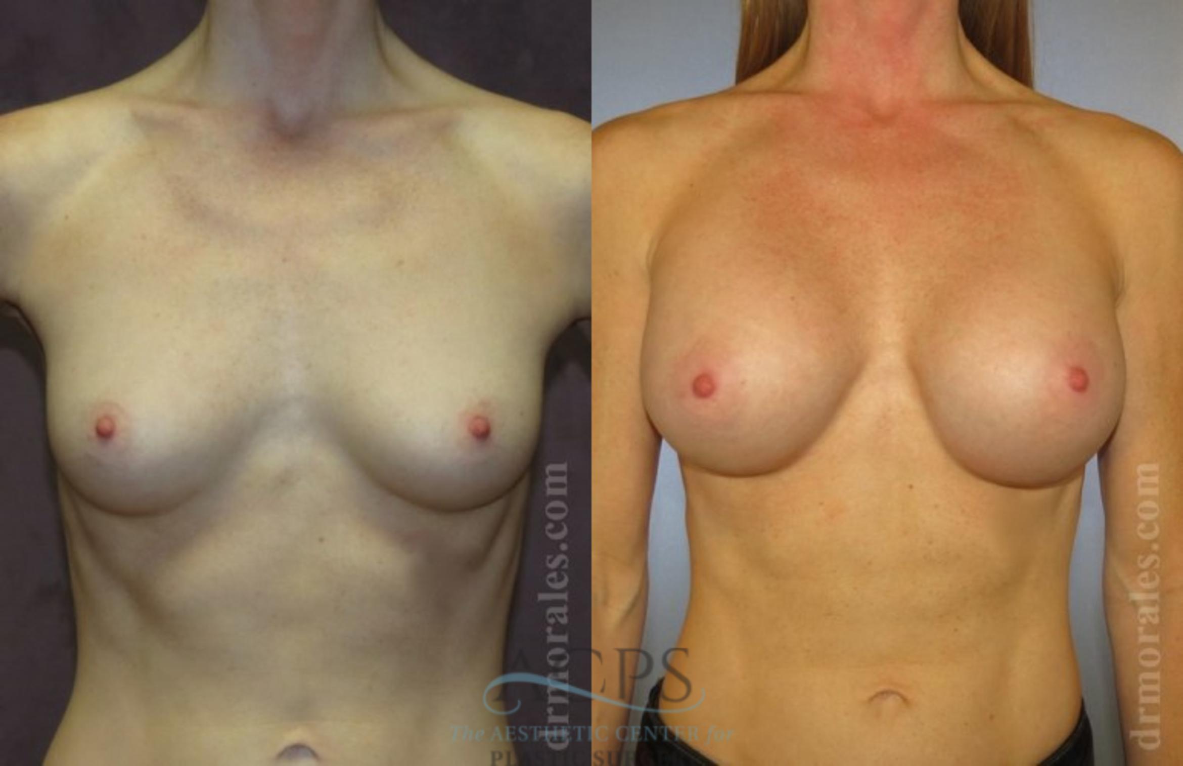 Before & After Breast Augmentation Case 1023 Front View: View in Houston, TX