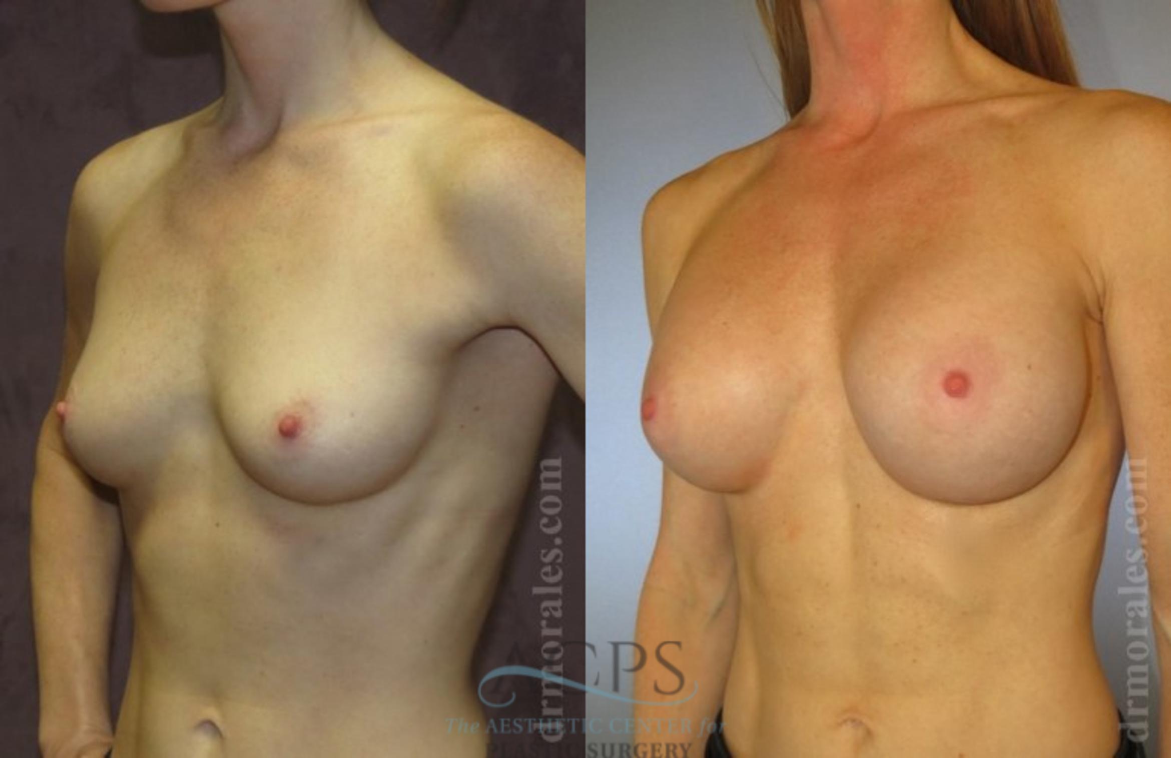 Before & After Breast Augmentation Case 1023 Oblique View: View in Houston, TX
