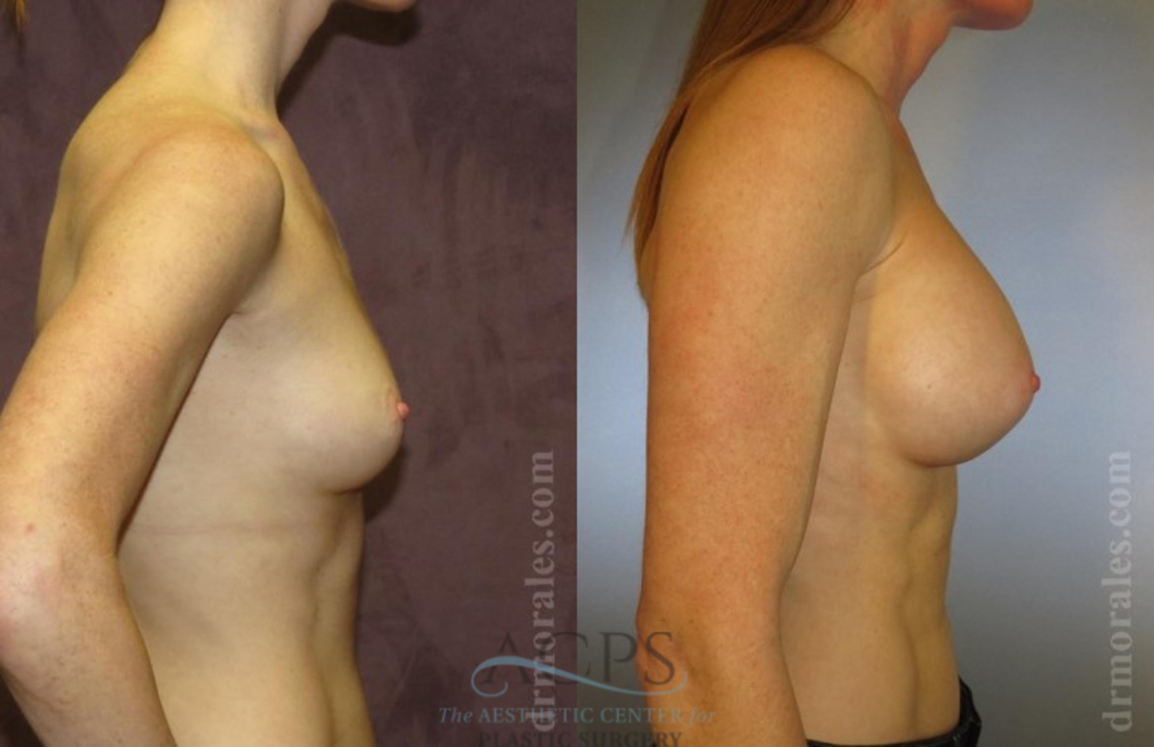 Before & After Breast Augmentation Case 1023 Side View: View in Houston, TX