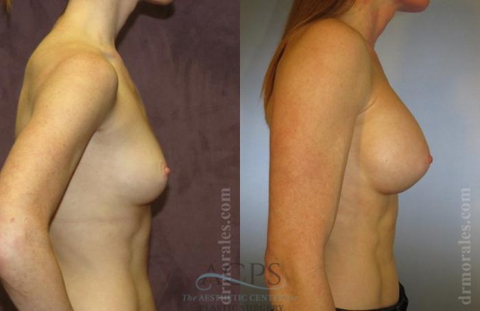 Before & After Breast Augmentation Case 1023 Side View: View in Houston, TX