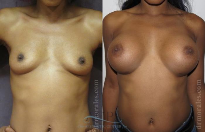 Before & After Breast Augmentation Case 1024 Front View: View in Houston, TX