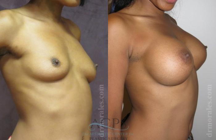 Before & After Breast Augmentation Case 1024 Oblique View: View in Houston, TX