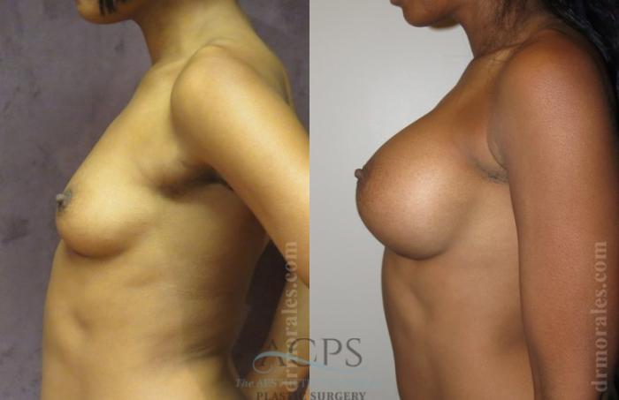Before & After Breast Augmentation Case 1024 Side View: View in Houston, TX