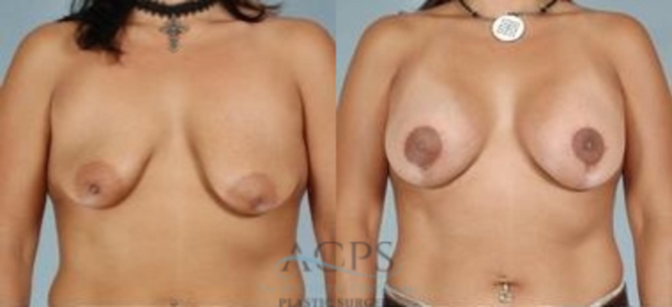 Before & After Breast Augmentation Case 1025 Front View: View in Houston, TX