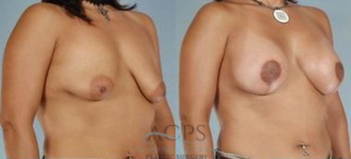 Before & After Breast Augmentation Case 1025 Oblique View: View in Houston, TX