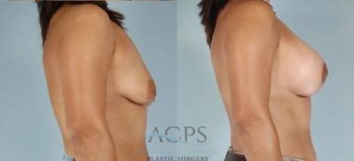 Before & After Breast Augmentation Case 1025 Side View: View in Houston, TX