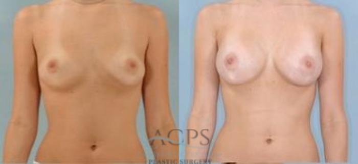Before & After Breast Augmentation Case 1026 Front View: View in Houston, TX