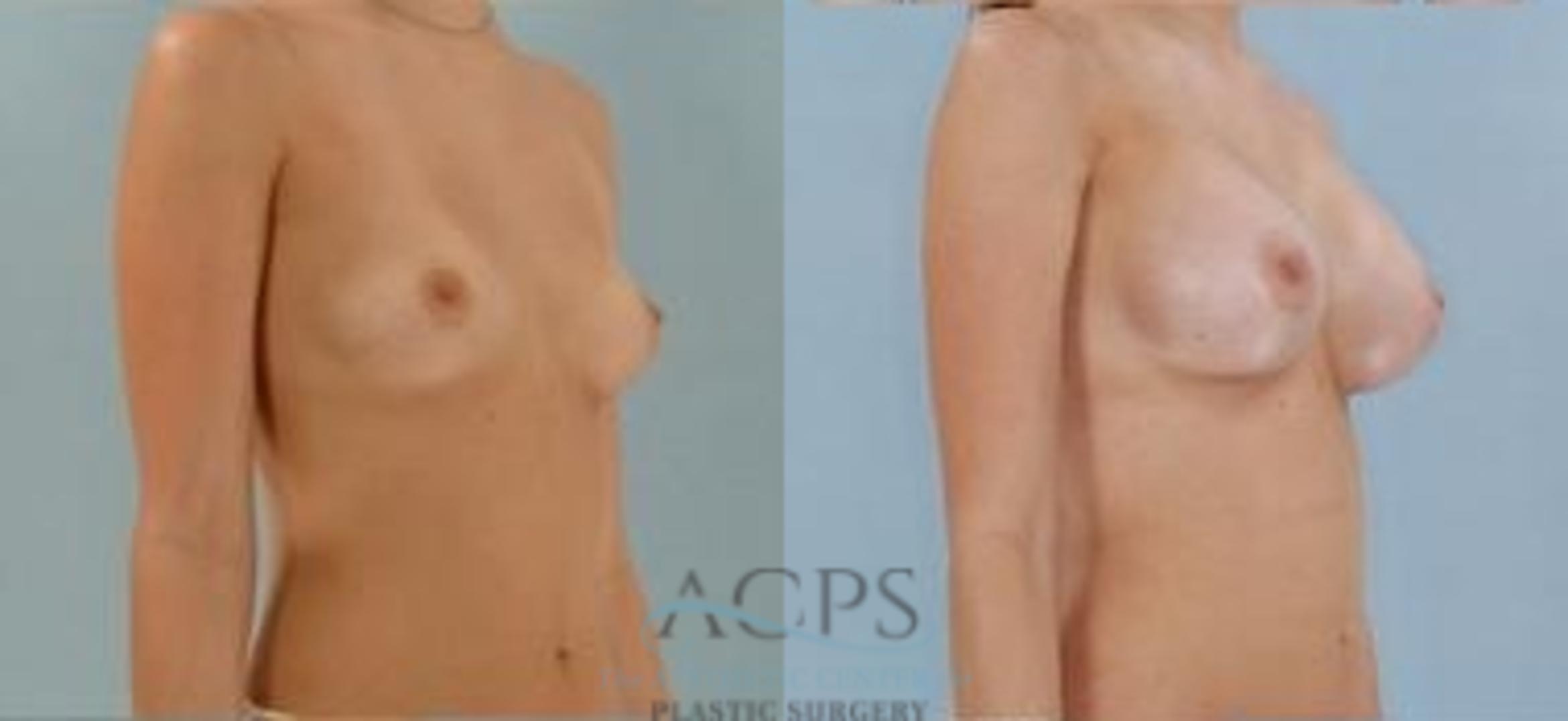 Before & After Breast Augmentation Case 1026 Oblique View: View in Houston, TX