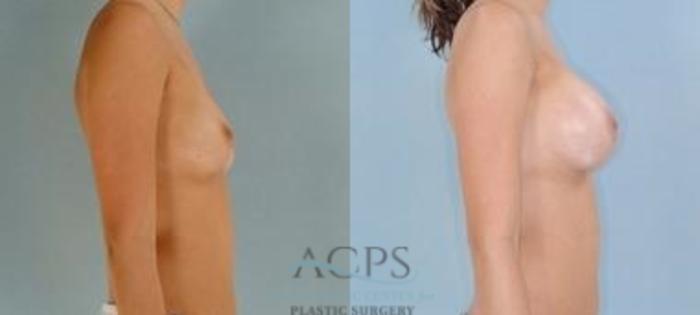 Before & After Breast Augmentation Case 1026 Side View: View in Houston, TX