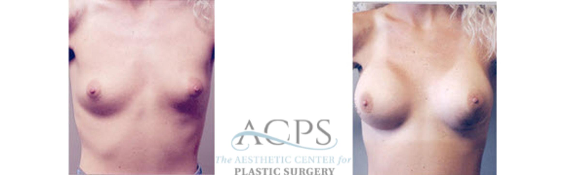 Before & After Breast Augmentation Case 1027 Front View: View in Houston, TX