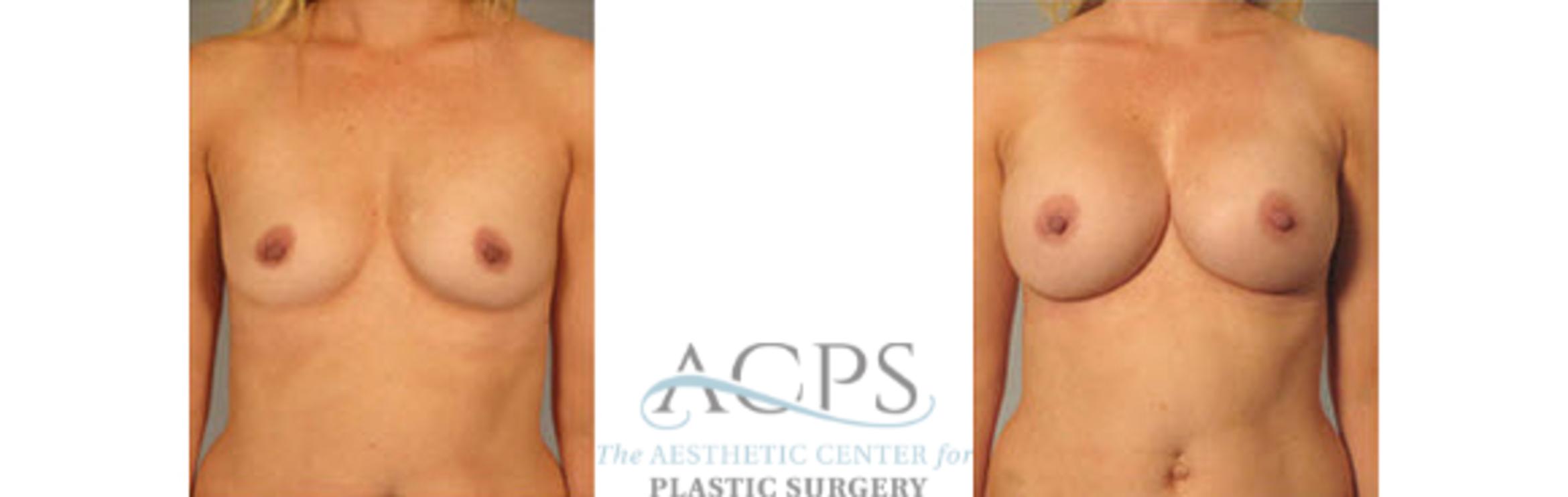 Before & After Breast Augmentation Case 1028 Front View: View in Houston, TX