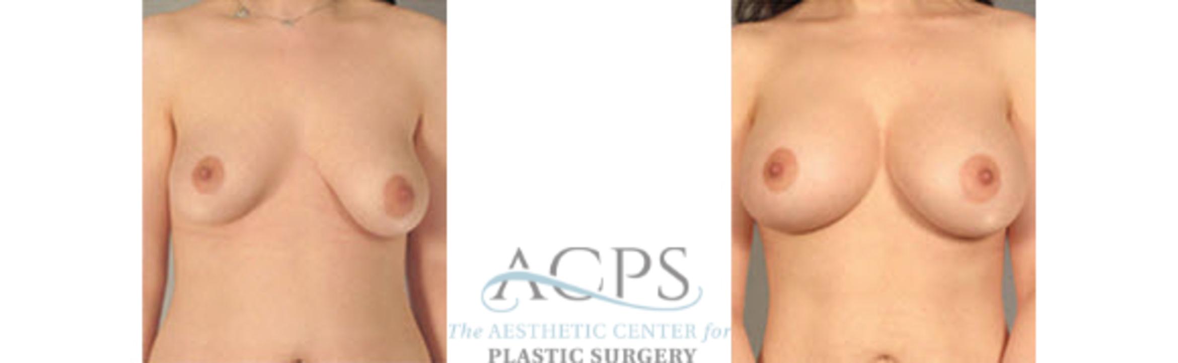 Before & After Breast Augmentation Case 1029 Front View: View in Houston, TX