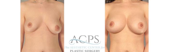 Before & After Breast Augmentation Case 1029 Front View: View in Houston, TX
