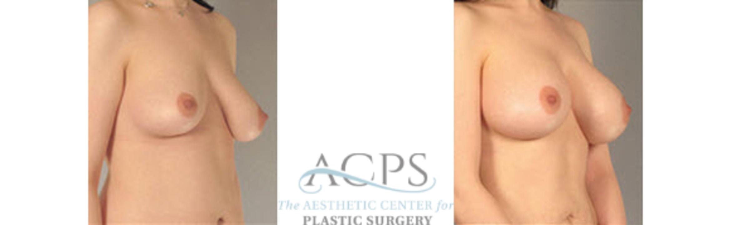 Before & After Breast Augmentation Case 1029 Oblique View: View in Houston, TX