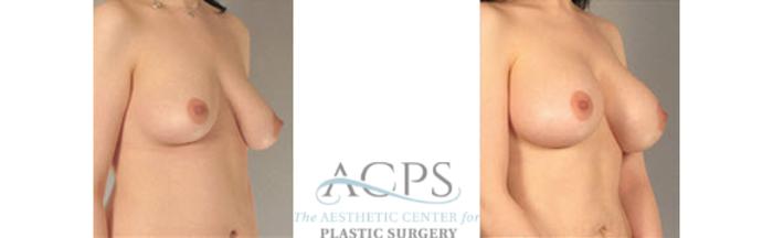 Before & After Breast Augmentation Case 1029 Oblique View: View in Houston, TX