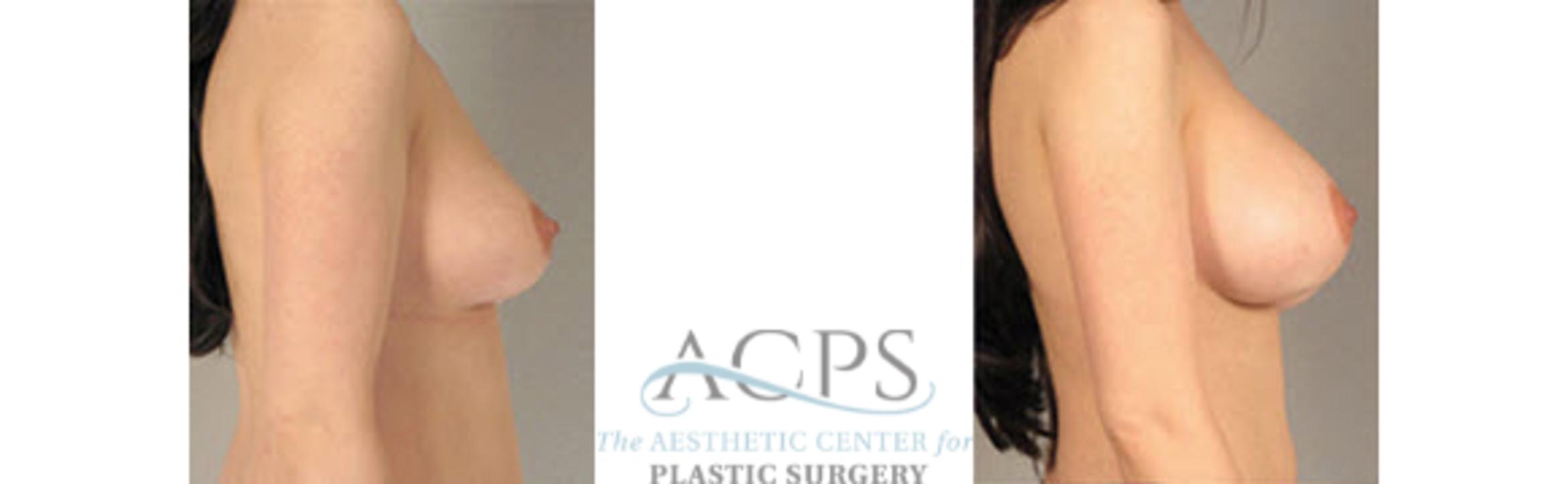 Before & After Breast Augmentation Case 1029 Side View: View in Houston, TX