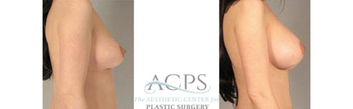Before & After Breast Augmentation Case 1029 Side View: View in Houston, TX