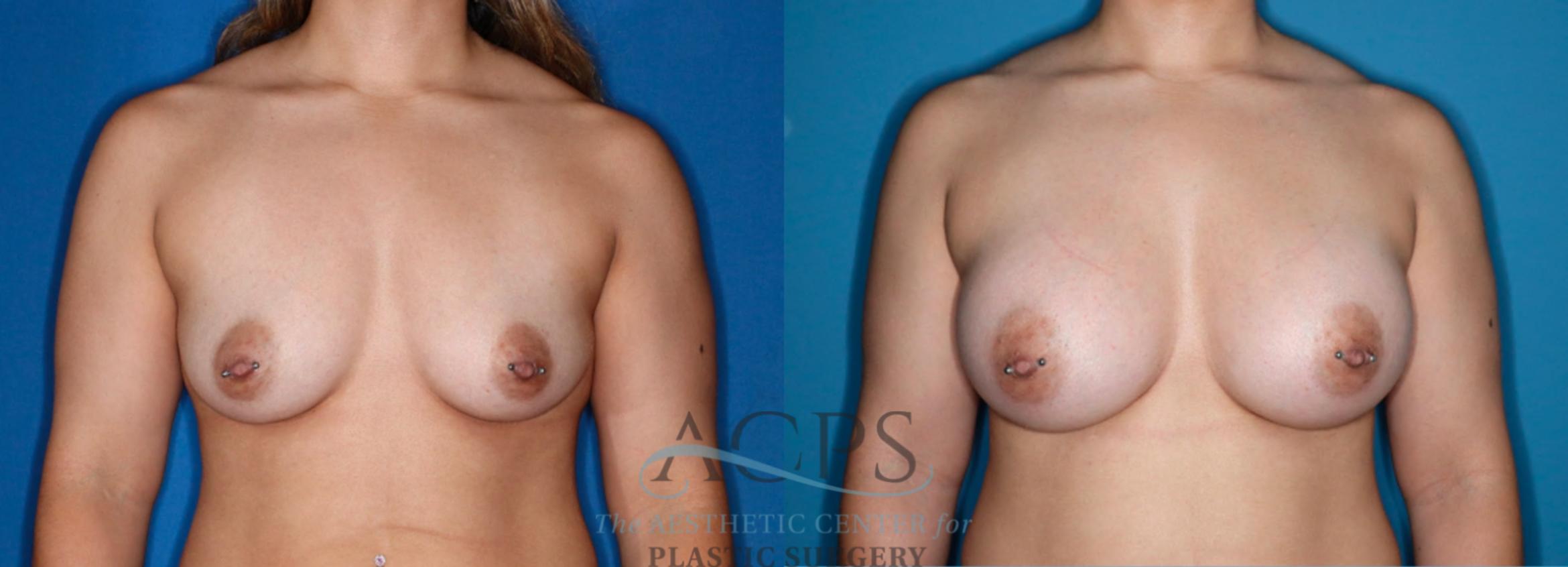 Before & After Breast Augmentation Case 1526 Front View in Houston, TX