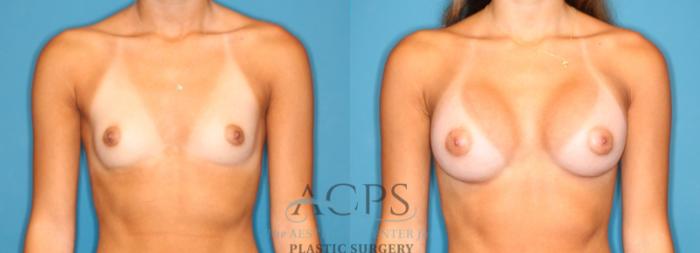 Before & After Breast Augmentation Case 1547 Front View in Houston, TX