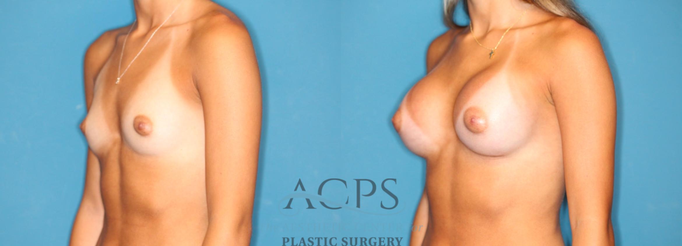 Before & After Breast Augmentation Case 1547 Left Oblique View in Houston, TX