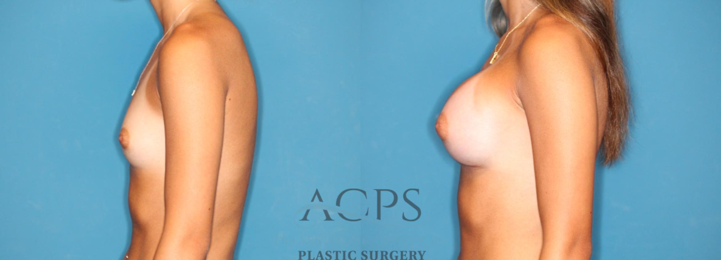 Before & After Breast Augmentation Case 1547 Left Side View in Houston, TX