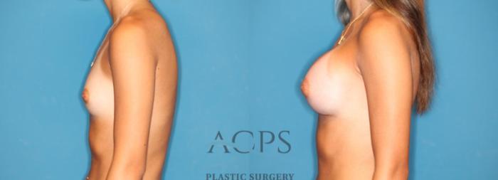 Before & After Breast Augmentation Case 1547 Left Side View in Houston, TX