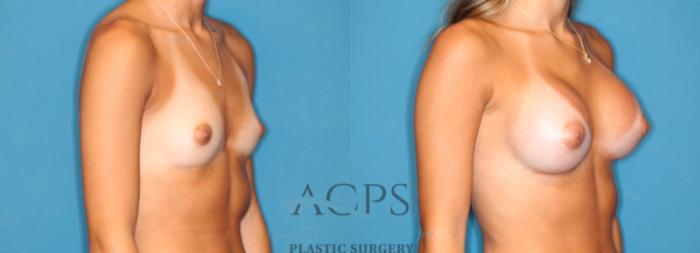 Before & After Breast Augmentation Case 1547 Right Oblique View in Houston, TX
