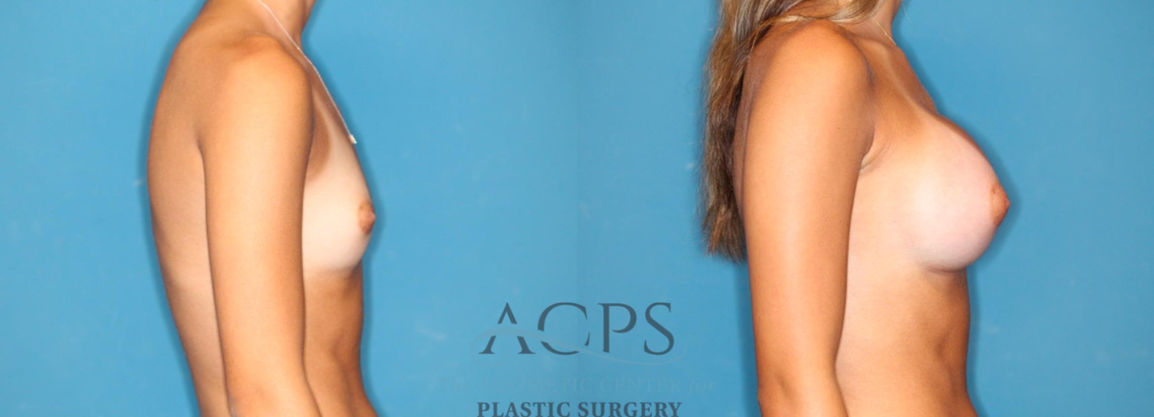Before & After Breast Augmentation Case 1547 Right Side View in Houston, TX