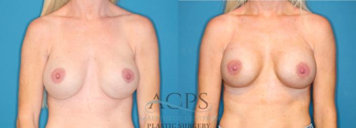 Before & After Breast Augmentation Case 1548 Front View in Houston, TX