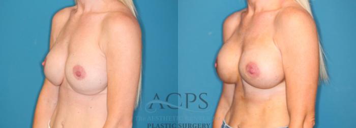 Before & After Breast Augmentation Case 1548 Left Oblique View in Houston, TX