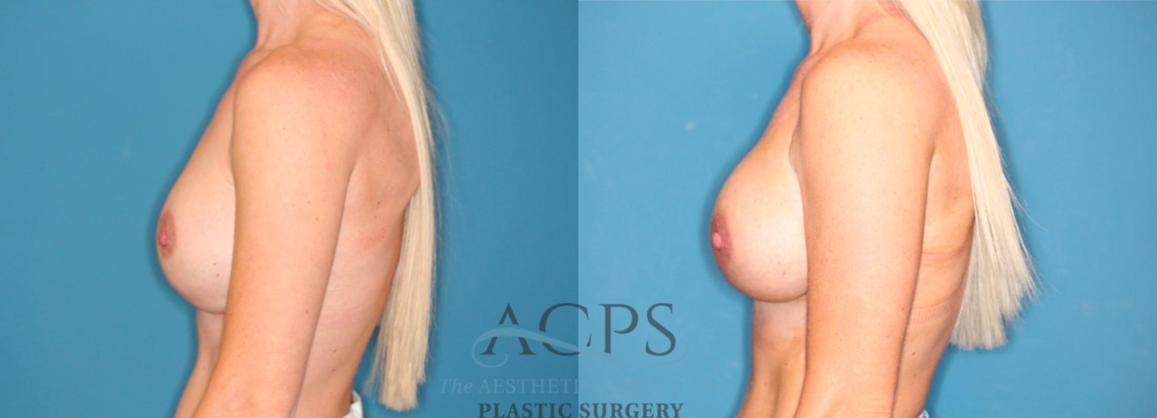 Before & After Breast Augmentation Case 1548 Left Side View in Houston, TX