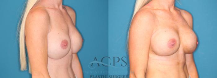 Before & After Breast Augmentation Case 1548 Right Oblique View in Houston, TX