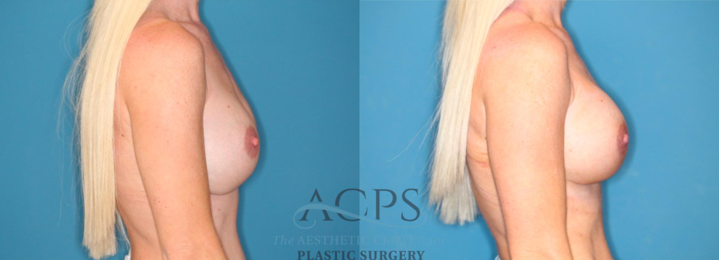 Before & After Breast Augmentation Case 1548 Right Side View in Houston, TX