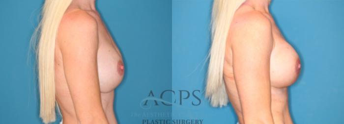 Before & After Breast Augmentation Case 1548 Right Side View in Houston, TX