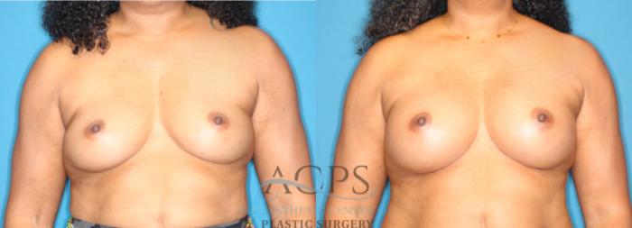 Before & After Breast Augmentation Case 1552 Front View in Houston, TX