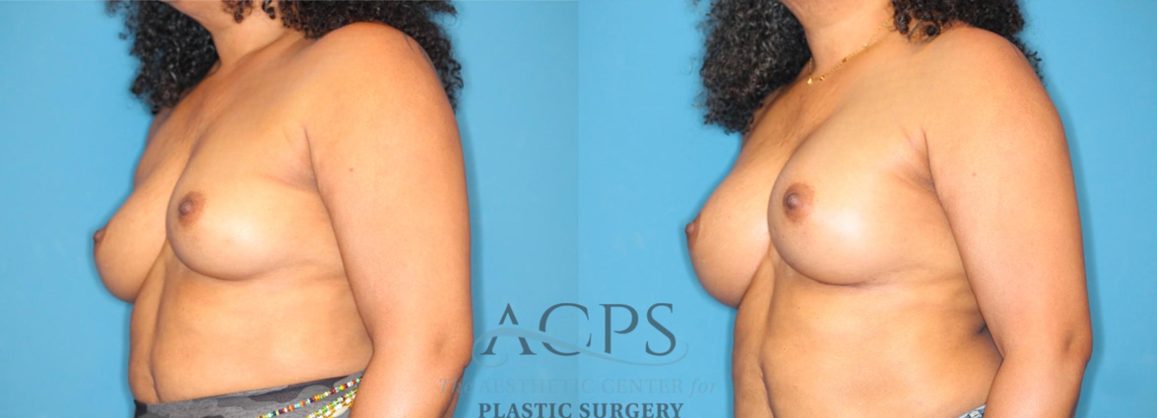 Before & After Breast Augmentation Case 1552 Left Oblique View in Houston, TX