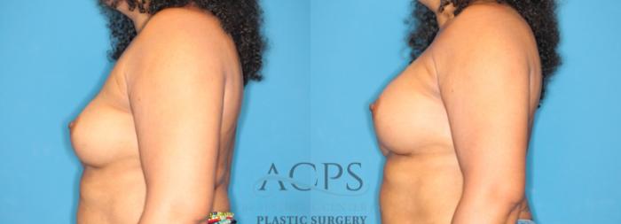 Before & After Breast Augmentation Case 1552 Left Side View in Houston, TX