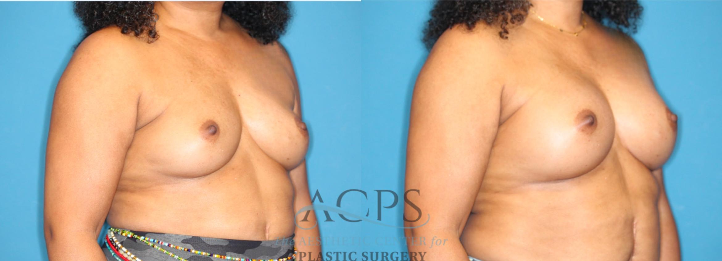 Before & After Breast Augmentation Case 1552 Right Oblique View in Houston, TX