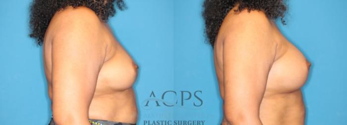 Before & After Breast Augmentation Case 1552 Right Side View in Houston, TX