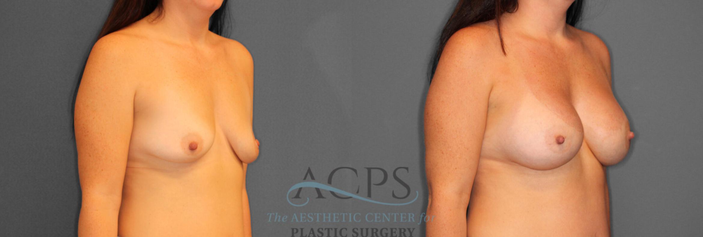 Before & After Breast Augmentation Case 803 Oblique View: View in Houston, TX
