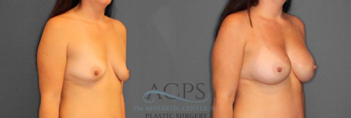 Before & After Breast Augmentation Case 803 Oblique View: View in Houston, TX