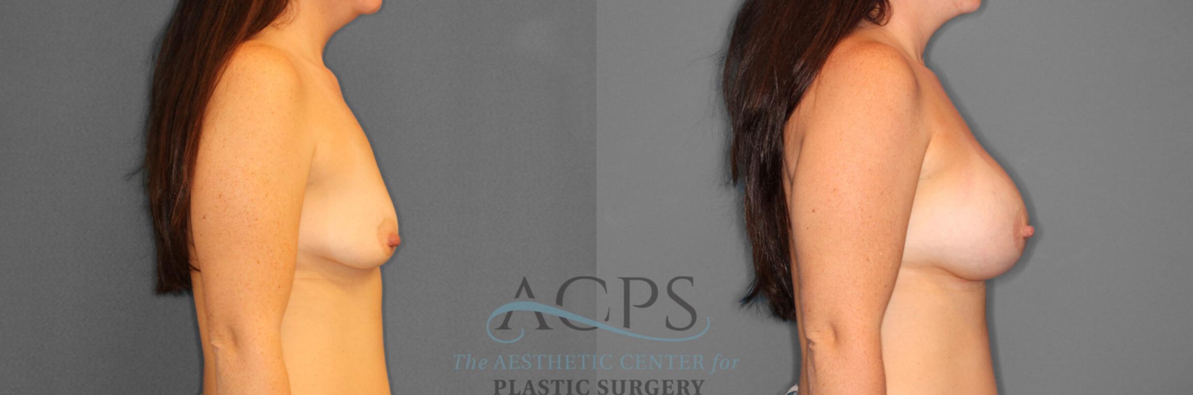 Before & After Breast Augmentation Case 803 Right Side View: View in Houston, TX