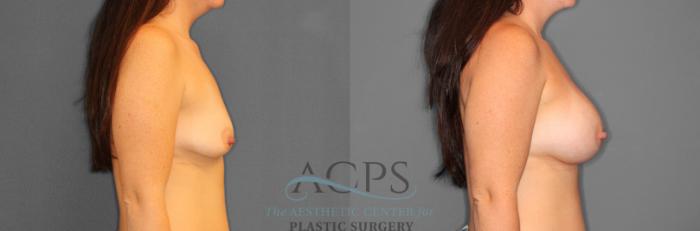 Before & After Breast Augmentation Case 803 Right Side View: View in Houston, TX