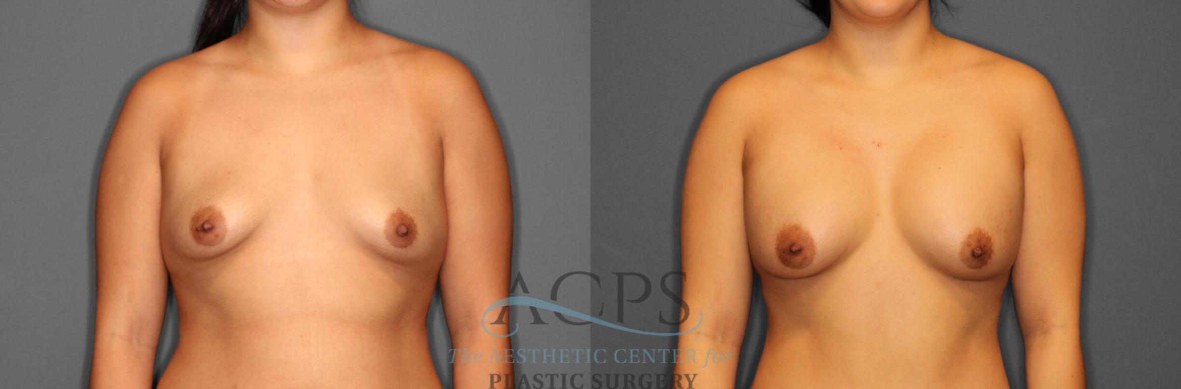 Before & After Breast Augmentation Case 804 Front View: View in Houston, TX
