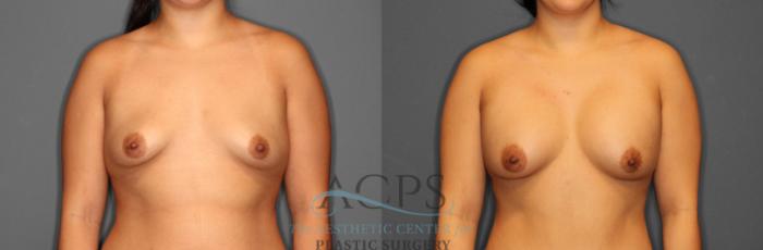 Before & After Breast Augmentation Case 804 Front View: View in Houston, TX