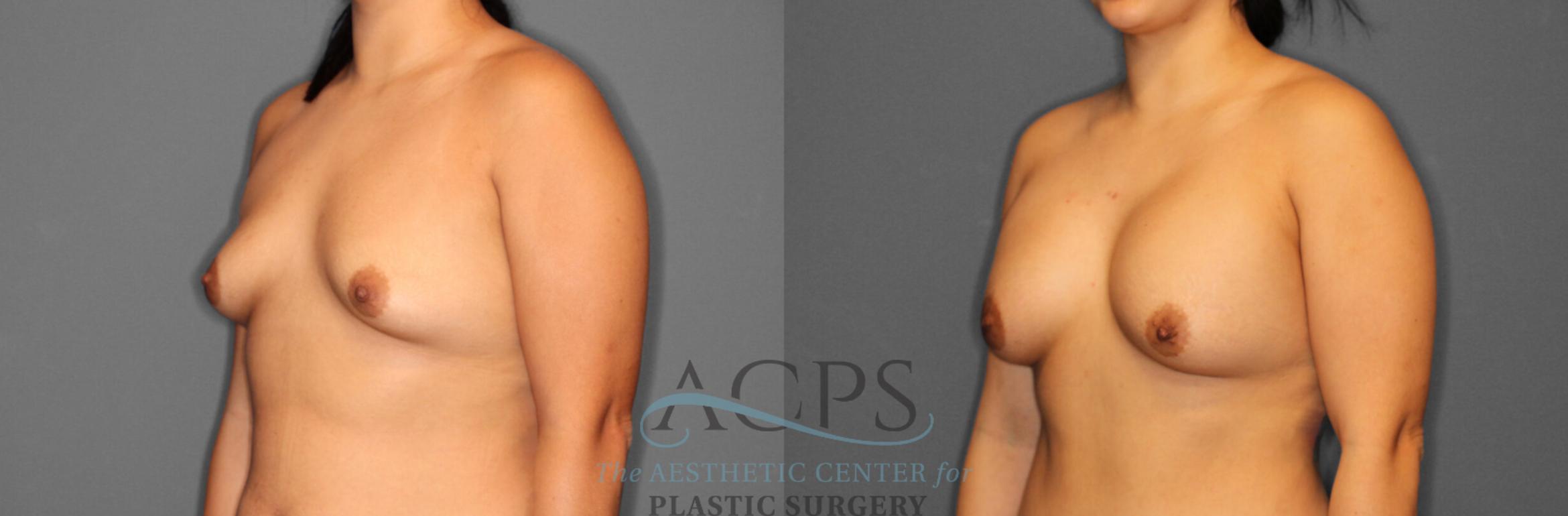Before & After Breast Augmentation Case 804 Oblique View: View in Houston, TX