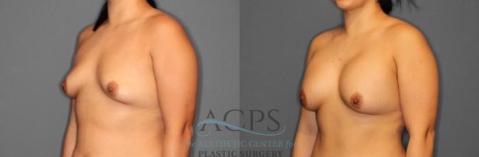 Before & After Breast Augmentation Case 804 Oblique View: View in Houston, TX